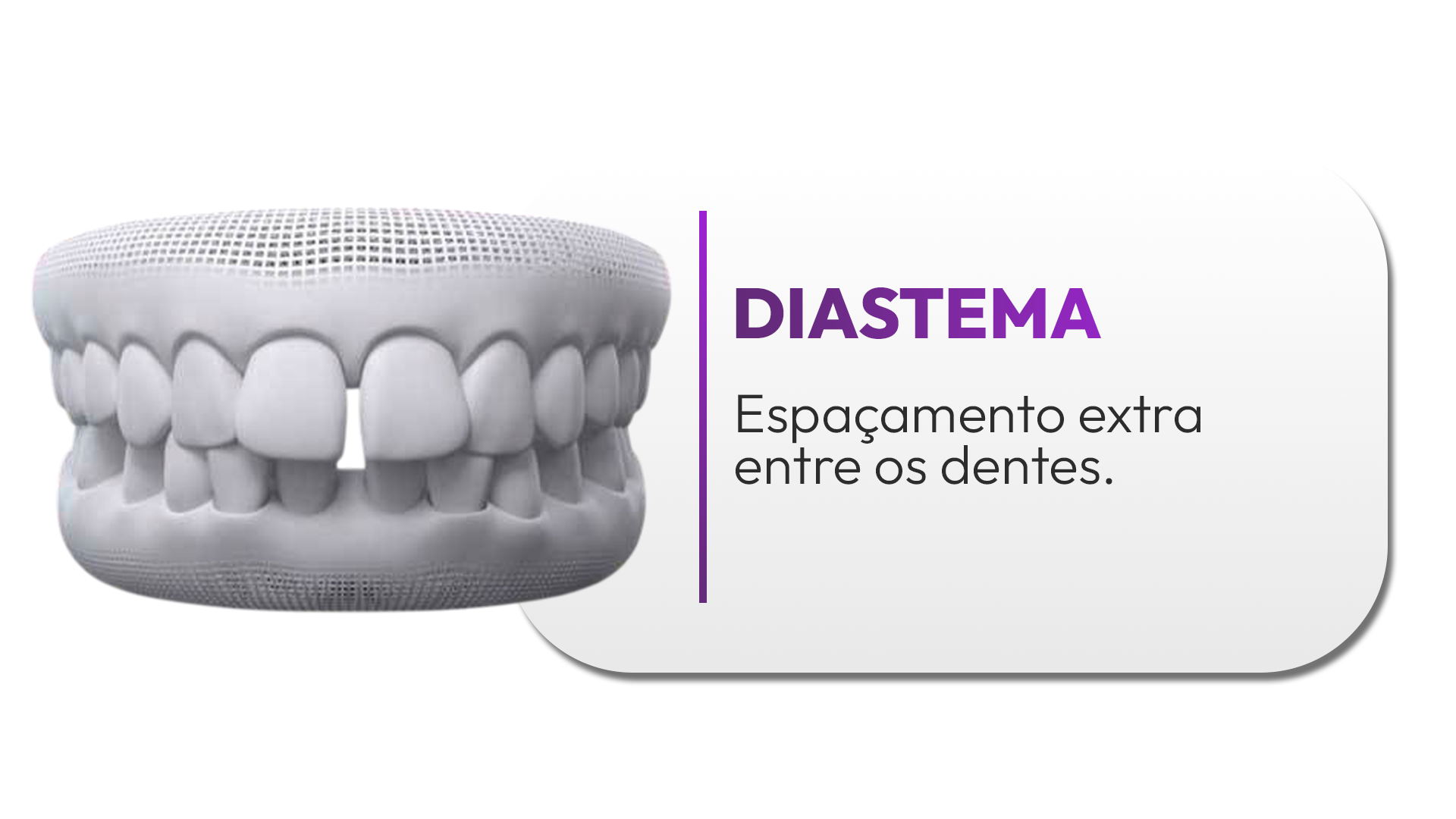 diastema