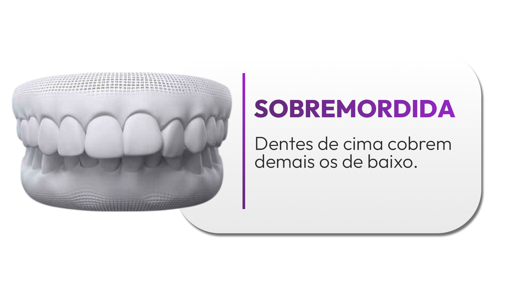 sobremordida